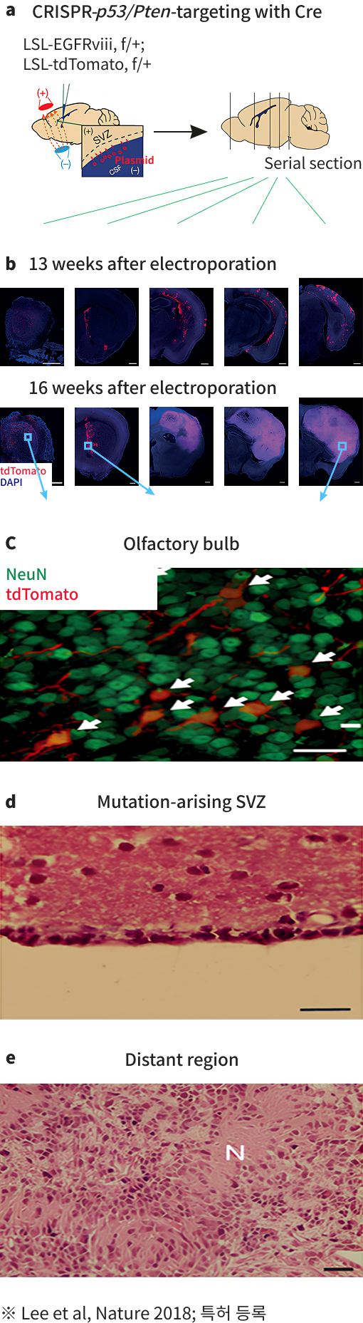 악성 뇌종양 모델 관련 이미지